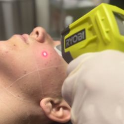Simply Skin Las Vegas - Laser Facials for acne!
