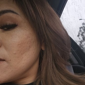 Skin So Sweet - I went in with congested skin and left with congested skin. I asked for an extraction and none was done. 5 facials for 500$& no results?! - Skin Care Near Me - Huntington Beach, California Skin So Sweet - I went in with congested skin and left with congested skin. I asked for an extraction and none was done. 5 facials for 500$& no results?! - Skin Care Near Me - Huntington Beach, California