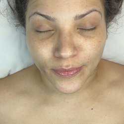 IX3 Esthetics - Basic facial with exfoliation after picture
