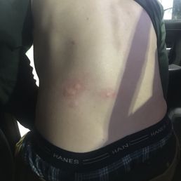 Bed bug bites Bed bug bites