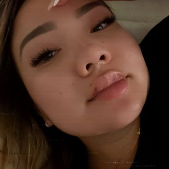 ME Medical Spa - One day after my service - Medical Spas Near Me - San Jose, California