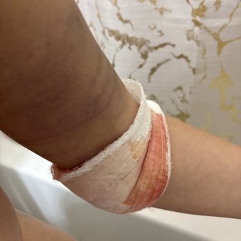 Diamond Post Care - Would get irritated to change bandages would make you wait until following day - Bed & Breakfast Near Me - Miami, Florida