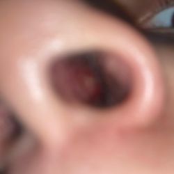 Sherry Levine, MD - Week after surgery