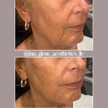 Nu Glow Aesthetics - Medical Spas Near Me - Aliquippa, Pennsylvania Nu Glow Aesthetics - Medical Spas Near Me - Aliquippa, Pennsylvania