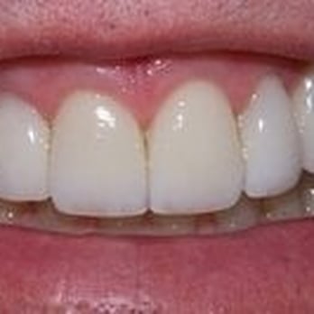 Stephen Coates, DDS - After Treatment Edward D. - Cosmetic Dentists Near Me - Long Beach, California