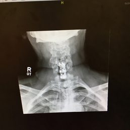 Cervical fusion performed by Dr. Scott Lee Cervical fusion performed by Dr. Scott Lee