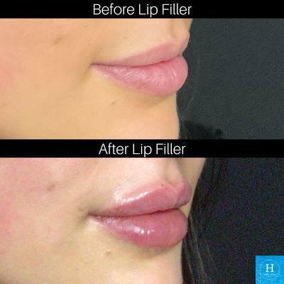 Lip Filler Treatments - Lip Filler Treatments at Healthy Solutions Medspa
Enhance your natural beauty with expertly performed lip filler/lip injection treatments at Healthy Solutions Medspa, a leading aesthetic practice recognized in the top 5% of Botox and Filler providers nationwide.
Our experienced team of medical professionals and Nurse Practitioners specialize in creating natural, balanced, and beautiful results. Whether you’re looking to add volume, define your lip shape, or smooth fine lines.
Using only FDA-approved fillers and advanced injection techniques, we tailor every treatment to your unique features and goals for subtle, confidence-boosting results.
Healthy Solutions Medspa proudly serves patients from two convenient locations in Furlong and Ivyland, Pennsylvania, offering a full range of non-surgical treatments for facial rejuvenation, skin health, weight loss and body contouring.
✨ Why patients love us:
Top 5% Botox & Filler provider in the U.S.
Expert, experienced injectors
Personalized consultations and treatment plans
Natural-looking, long-lasting results
📍 Locations:
Ivyland, PA
Furlong, PA
💉 Book your lip filler consultation today and discover why Healthy Solutions Medspa is Bucks County’s most trusted destination for injectables and aesthetic care. Lip Filler Treatments - Lip Filler Treatments at Healthy Solutions Medspa
Enhance your natural beauty with expertly performed lip filler/lip injection treatments at Healthy Solutions Medspa, a leading aesthetic practice recognized in the top 5% of Botox and Filler providers nationwide.
Our experienced team of medical professionals and Nurse Practitioners specialize in creating natural, balanced, and beautiful results. Whether you’re looking to add volume, define your lip shape, or smooth fine lines.
Using only FDA-approved fillers and advanced injection techniques, we tailor every treatment to your unique features and goals for subtle, confidence-boosting results.
Healthy Solutions Medspa proudly serves patients from two convenient locations in Furlong and Ivyland, Pennsylvania, offering a full range of non-surgical treatments for facial rejuvenation, skin health, weight loss and body contouring.
✨ Why patients love us:
Top 5% Botox & Filler provider in the U.S.
Expert, experienced injectors
Personalized consultations and treatment plans
Natural-looking, long-lasting results
📍 Locations:
Ivyland, PA
Furlong, PA
💉 Book your lip filler consultation today and discover why Healthy Solutions Medspa is Bucks County’s most trusted destination for injectables and aesthetic care.