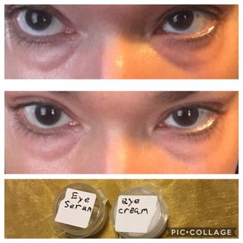 Infinite Beauty - Just wanted to post a pic after trying out the samples that Infinite Beauty sent. Top pic is before. Bottom 2 hours later. - Skin Care Near Me - White Plains, New York Infinite Beauty - Just wanted to post a pic after trying out the samples that Infinite Beauty sent. Top pic is before. Bottom 2 hours later. - Skin Care Near Me - White Plains, New York