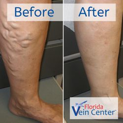 Florida Vein Center