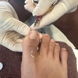Ingrown nails removed Ingrown nails removed