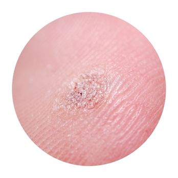 Goodskin Dermatology - Similar to what mine looked like but mine looked even less threatening. - Dermatologists Near Me - Hillsboro, Oregon Goodskin Dermatology - Similar to what mine looked like but mine looked even less threatening. - Dermatologists Near Me - Hillsboro, Oregon