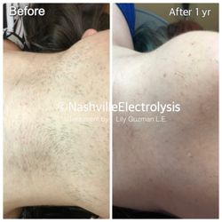 Nashville Electrolysis - Chin, jawline & neck, hair removal.  Only Electrolysis will get your facial hair off Permanently!