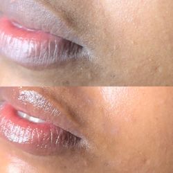 Oxygenation treatment