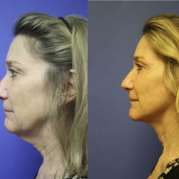 Matt Hershcovitch, MD - Mini Face and Neck Lift Before and After - Plastic Surgeons Near Me - Burbank, California