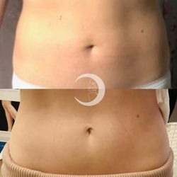 True Medical Aesthetics - My before and afters from emsculpt