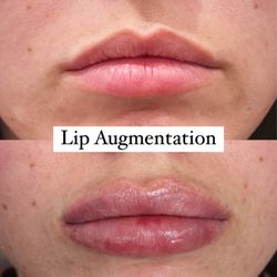 Glam MediSpa - Lip Augmentation