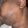 Fort Worth Electrolysis gift card