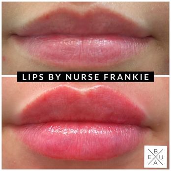 Beaux MedSpa - Austin Natural looking Lip Filler - Medical Spas Near Me - Austin, Texas