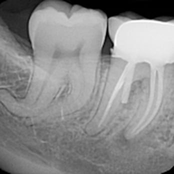Wheaton Family Dental Care - The post that was put through my tooth and has been stuck in my jaw, which resulted in extraction and a bone graft on 11/12/2014 - General Dentistry Near Me - Wheaton, Illinois Wheaton Family Dental Care - The post that was put through my tooth and has been stuck in my jaw, which resulted in extraction and a bone graft on 11/12/2014 - General Dentistry Near Me - Wheaton, Illinois