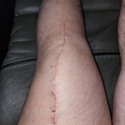 Total Orthopedics And Sports Medicine - Massapequa - 3 weeks, barely see a scar