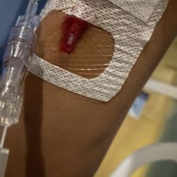 Banner Desert Medical Center - Vein looks busted