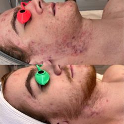 The Sacramento Esthetician - Four months progress with facials, home care and diet changes
