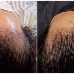 DAMO Hair Loss Clinic - My treatment result