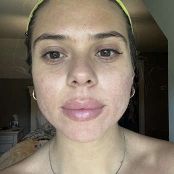 Savanna Boda - 7 1/2 months after consistent AM/PM skincare - Skin Care Near Me - Coppell, Texas Savanna Boda - 7 1/2 months after consistent AM/PM skincare - Skin Care Near Me - Coppell, Texas