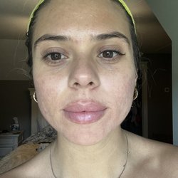 7 1/2 months after consistent AM/PM skincare