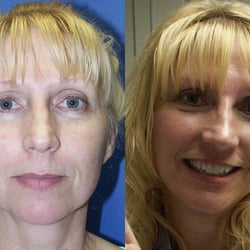 Sadi Erfani, MD - Facelift Procedure - Before & After.