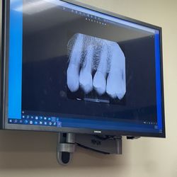 Beck W Barry, DDS, MD - Cracked chicklet!