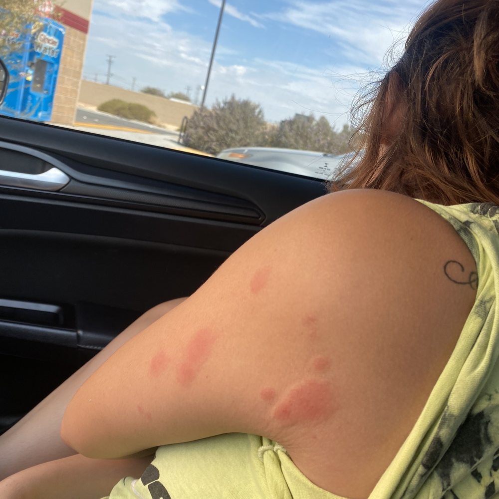 Boron Motel - bed bug bites - Hotels Near Me - Boron, California