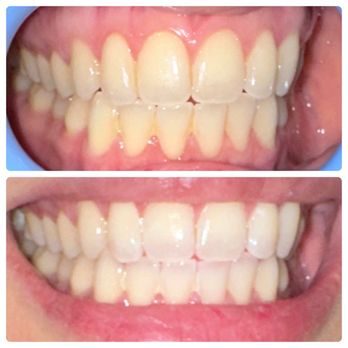 Moe's Teeth Whitening - Teeth Whitening Near Me - El Cajon, California Moe's Teeth Whitening - Teeth Whitening Near Me - El Cajon, California