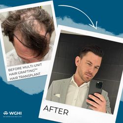 Talk about a complete transformation with a Multi-Unit Hair Grafting™ procedure from We Grow Hair Indy!