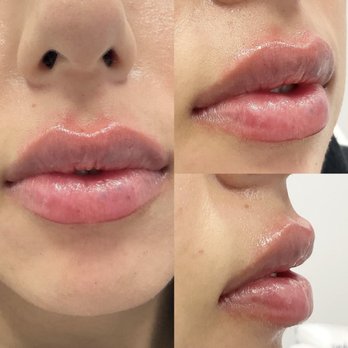 OrangeTwist - Lips by Nurse Darlene! - Medical Spas Near Me - Santa Clara, California OrangeTwist - Lips by Nurse Darlene! - Medical Spas Near Me - Santa Clara, California