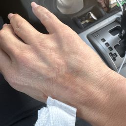 Blown vein Blown vein