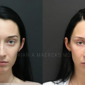 Rian A Maercks, MD - Aesthetic Facial Balancing - Before and After (Subtle aesthetic improvements to the eyes, lips and nose) - Cosmetic Surgeons Near Me - Miami, Florida Rian A Maercks, MD - Aesthetic Facial Balancing - Before and After (Subtle aesthetic improvements to the eyes, lips and nose) - Cosmetic Surgeons Near Me - Miami, Florida