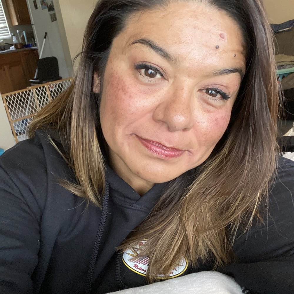 Joseph D Jensen, MD - 6 weeks later -dark spots are lighter - Dermatologists Near Me - Midvale, Utah Joseph D Jensen, MD - 6 weeks later -dark spots are lighter - Dermatologists Near Me - Midvale, Utah