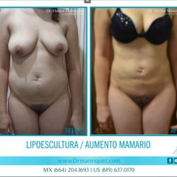 Dr. Manriquez - Liposculpture