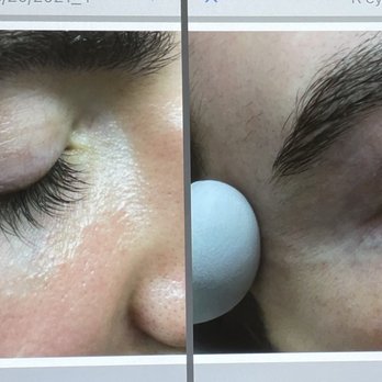 David Green, M.D. - Sclerotherapy before and after. - Dermatologists Near Me - Bethesda, Maryland