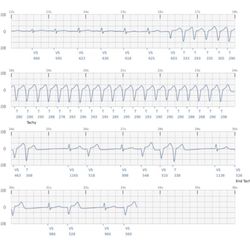 Apria Healthcare - This is a Boston Scientific Report showing ventricular tachycardia recorded by my son's heart monitor implant.