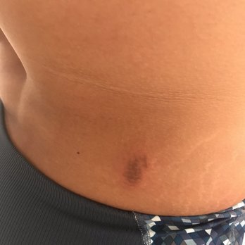 Seng Couture - Burns from exposed boning in my dress. - Accessories Near Me - N Plainfield, New Jersey Seng Couture - Burns from exposed boning in my dress. - Accessories Near Me - N Plainfield, New Jersey