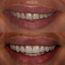 Alluna Dental - Before and After 10 beautiful porcelain veneers. This patient wanted a natural result and thats what we delivered!
