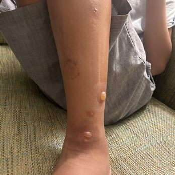 Germaine's Luau - L leg blisters - Hawaiian Near Me - Kapolei, Hawaii Germaine's Luau - L leg blisters - Hawaiian Near Me - Kapolei, Hawaii