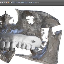 Eternadental - Using a CT scan, we are able to precisely plan the placement of implants