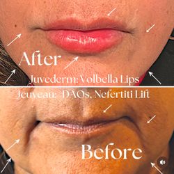 Skin Glo Aesthetics - Enhance your natural beauty! We used  Juvederm for luscious, plump lips and Jeuveau to relax DAOs and sculpt a stunning Nefertiti lift.