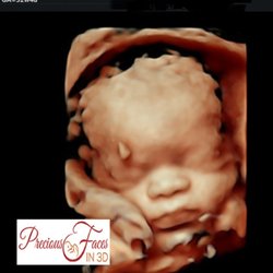 Precious Faces In 3D - GA 32w4d