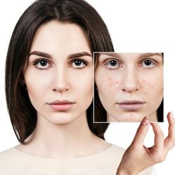 Venus Laser & Skincare - Acne Treatments