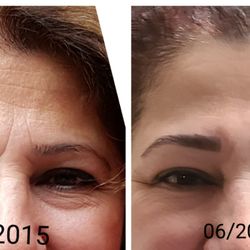 Golden Facial - My pictures 5 years ago and now after 2 fibroblast treatments. I'm so happy with the results.