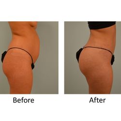 Denton Plastic Surgery - This patient received liposuction of her hip rolls & abdomen as well as a Brazilian Butt Lift.